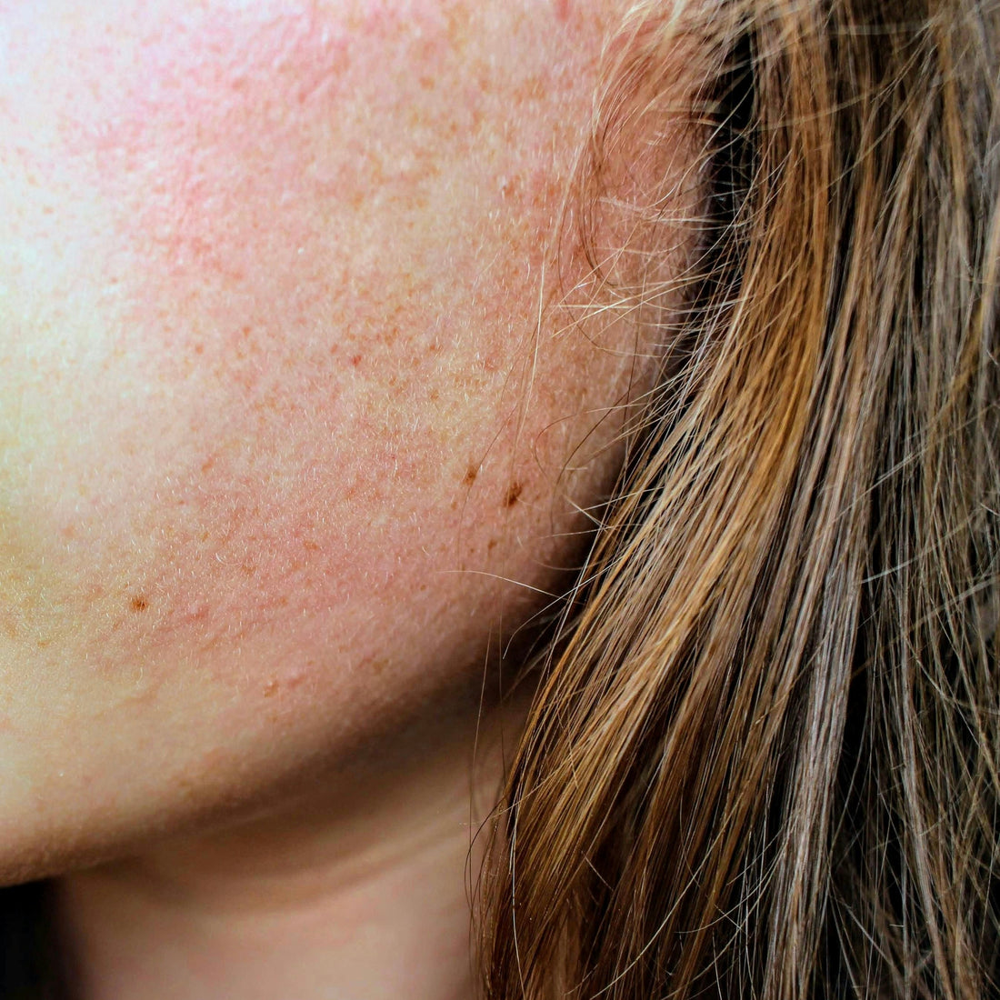 Dry Skin in Summer? Yes, It’s a Thing
