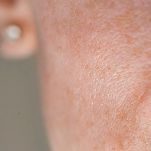 Can Retinol Dry Out Your Skin? Here’s How to Use It Without Irritation