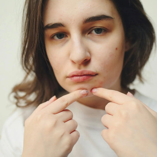 Spot Treatments vs. Prevention: The Best Way to Tackle Pimples