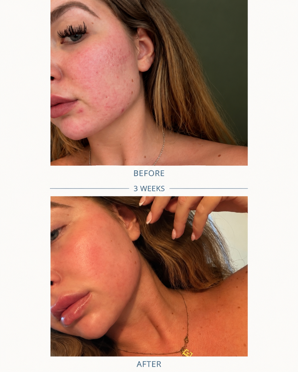 Close-up photos of a woman's cheek labelled before and after, three weeks apart